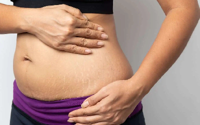 Stretch Marks Treatment in Santacruz