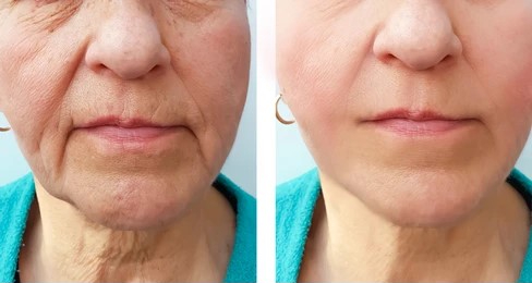 Dermal Filler Treatment in Mumbai