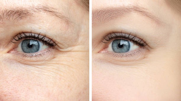 Dermal Filler Treatment in Mumbai
