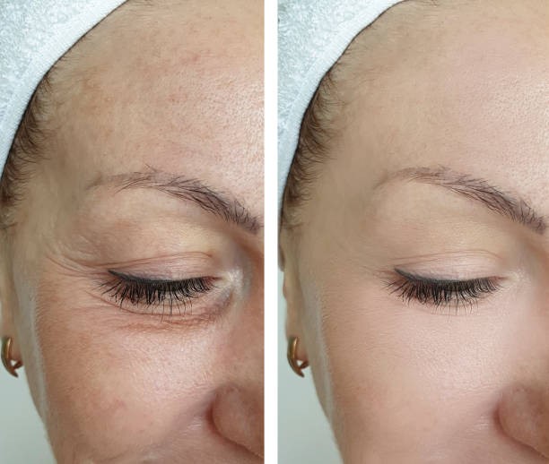 Aqualyx Treatment