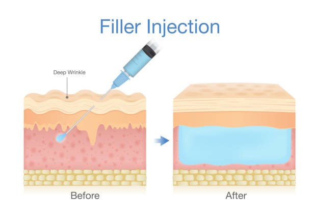 Cryolipolysis During Procedure - Dr. Viral Desai