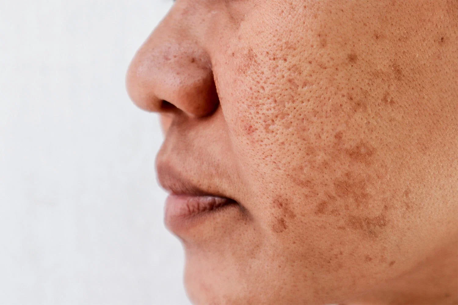 Pigmentation Treatment