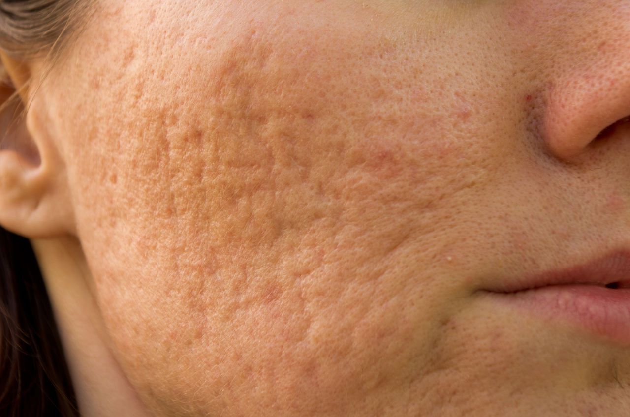 Acne Scar Removal Treatment