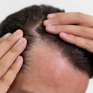 BOILS ON SCALP