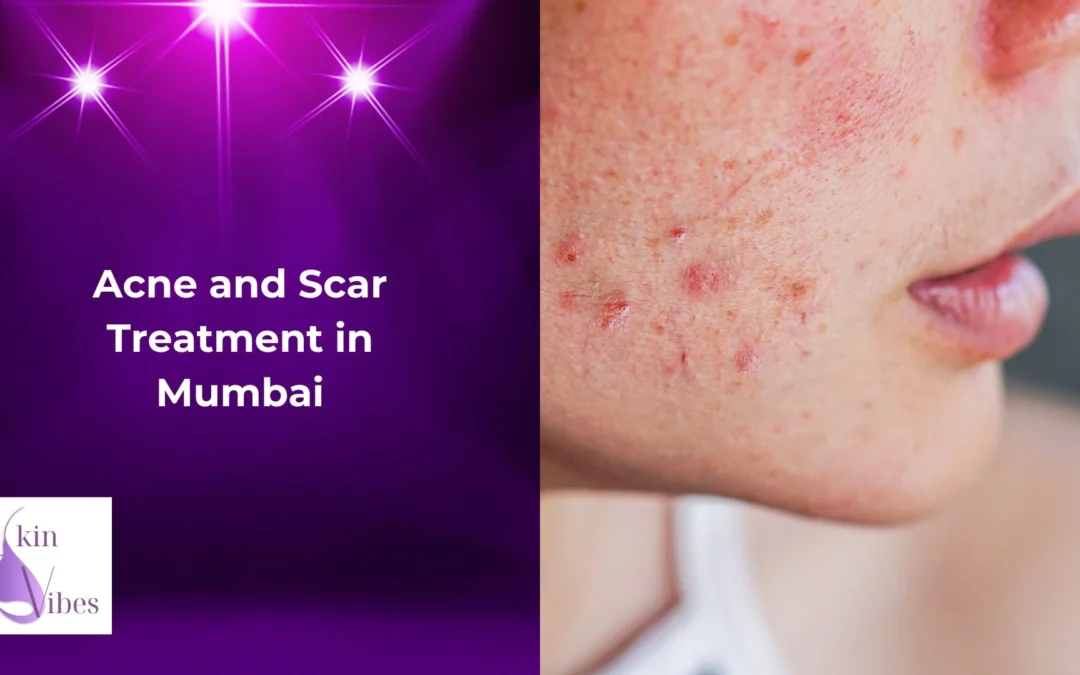 Acne and Scar Treatment in Mumbai