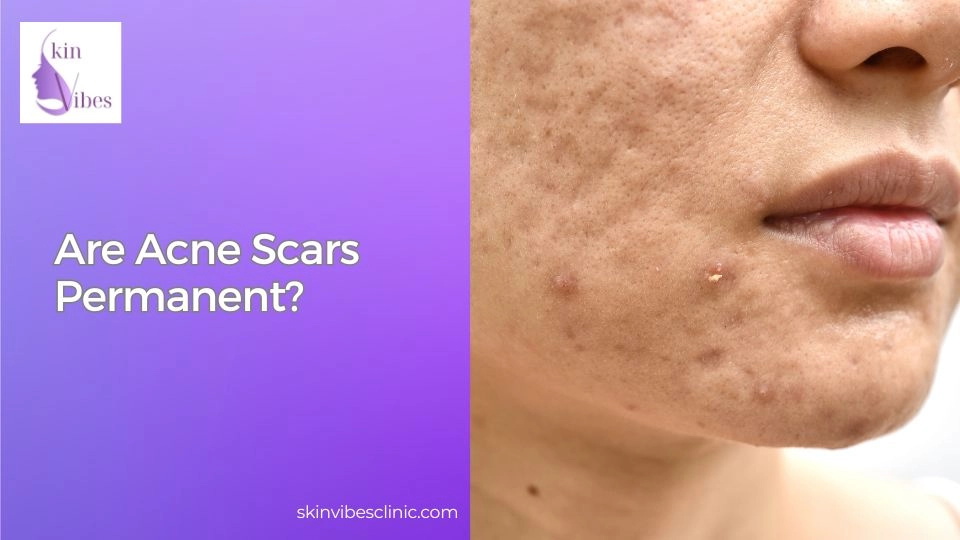 Are Acne Scars Permanent?
