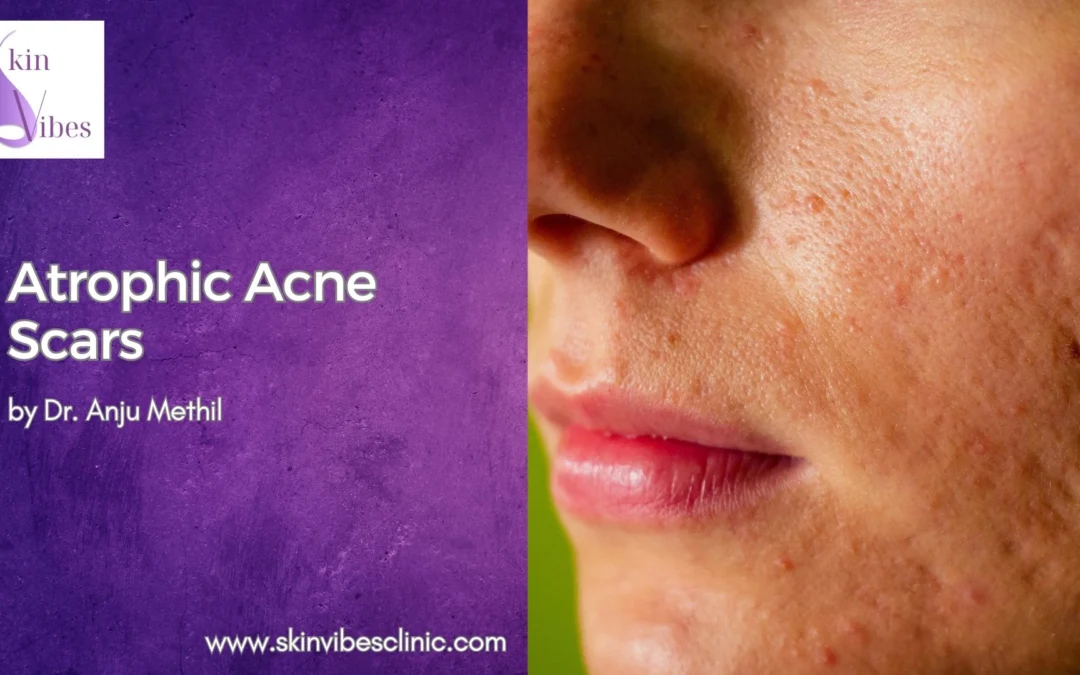  Atrophic Acne Scars