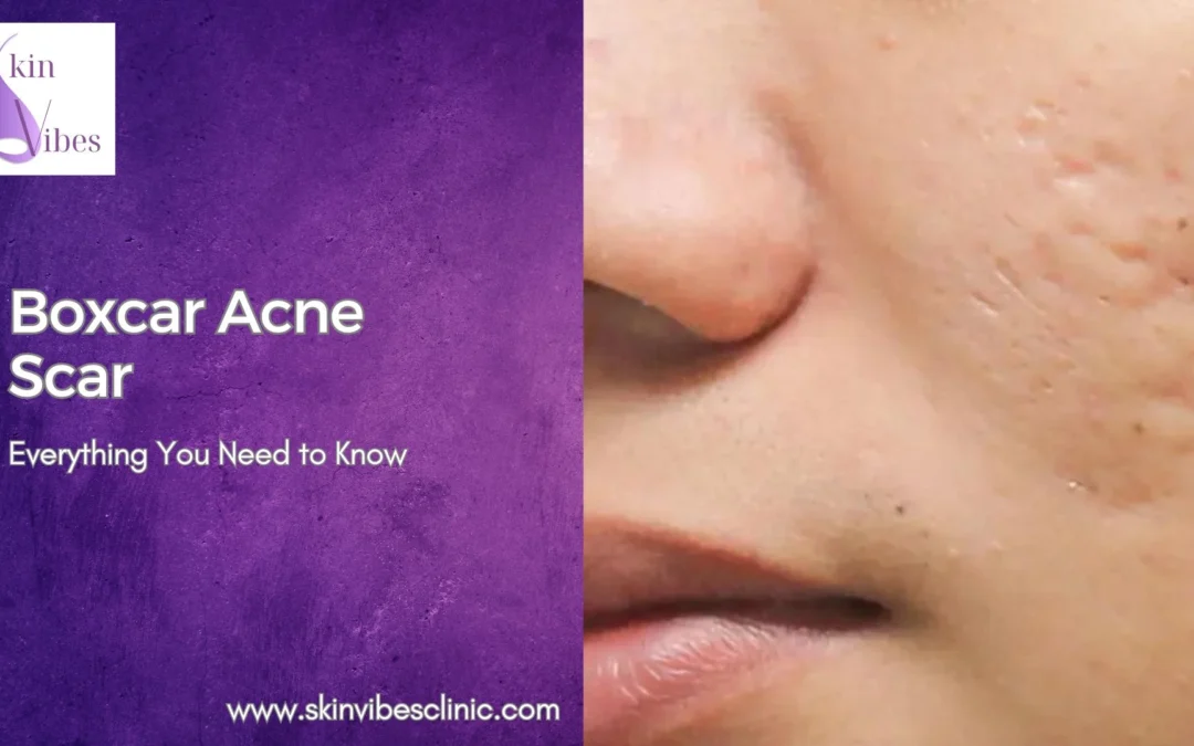 Boxcar Acne Scars: Everything You Need to Know