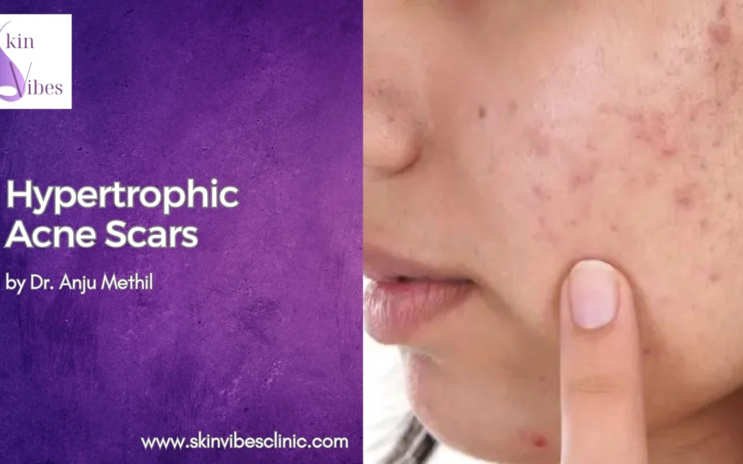 Hypertrophic Acne Scars: Your Complete Guide