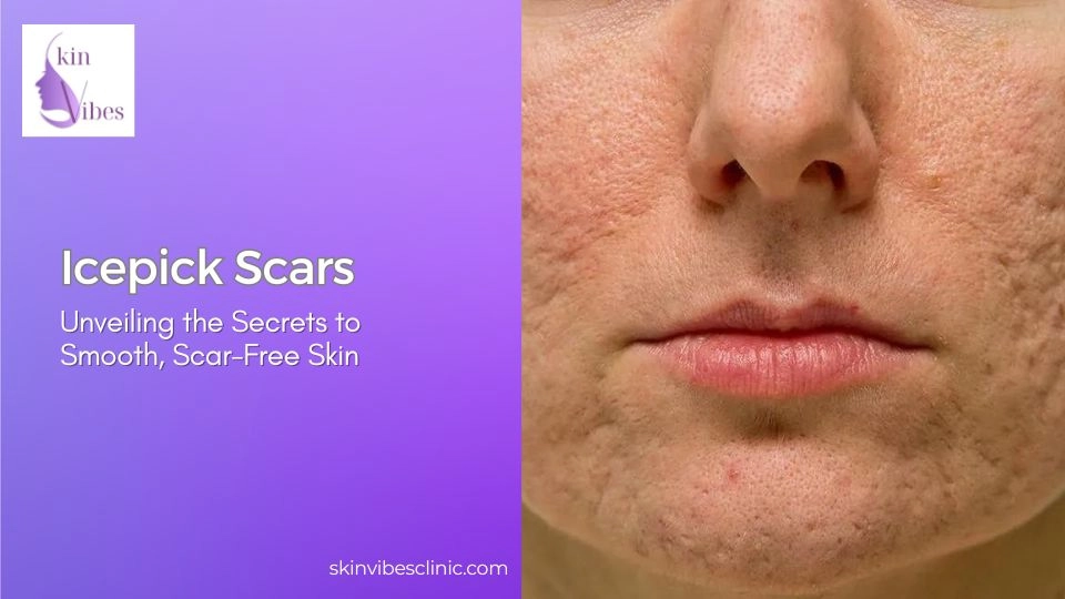 Icepick scars