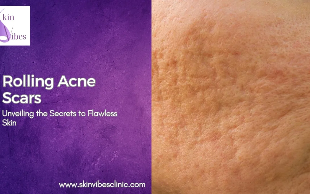 Rolling Acne Scars: Unveiling the Secrets to Flawless Skin