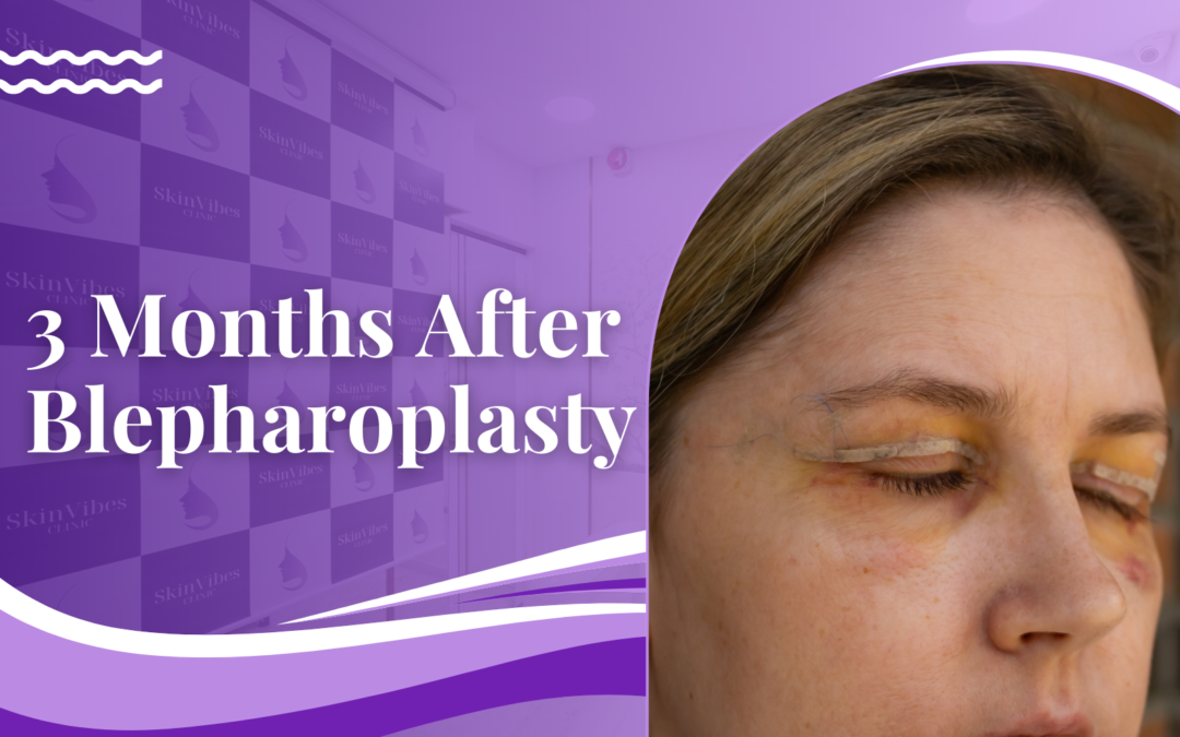 3 Months After Blepharoplasty