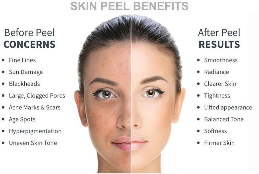 Types of Chemical Peels