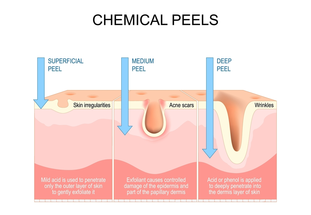 chemil peel