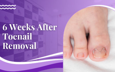 6 Weeks After Toenail Removal: What to Expect