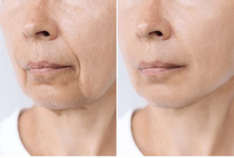 Who Is the Right Candidate for RF Skin Tightening?