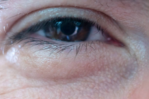 Swollen Eyelids After Botox - Causes