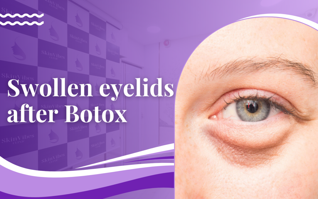 Swollen eyelids after Botox