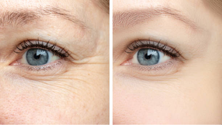 3 days after botox