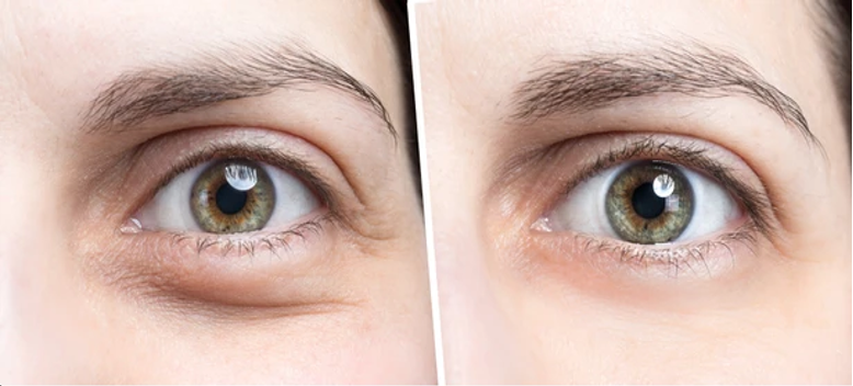Common Side Effects at Day 3 of Botox