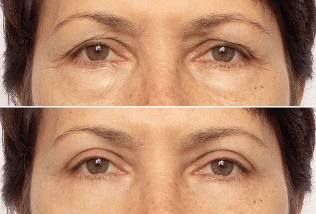 Is Swelling or Bruising Normal 3 Days After Botox